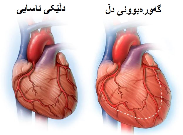 هۆکار و نیشانەکانی گەورەبوونی دڵ