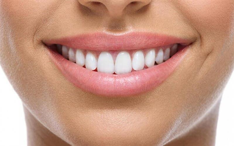التغذية والعادات تسبب تكون الطبقة الناعمة على الأسنان وتغير لونها