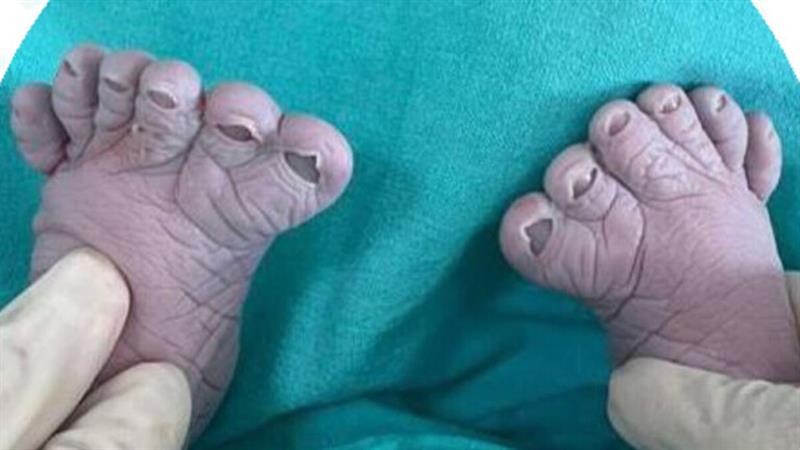 سيدة روسية تثير دهشة الأطباء بعدما أنجبت للمرة الثالثة طفلا بـ12 إصبعا في قدميه

