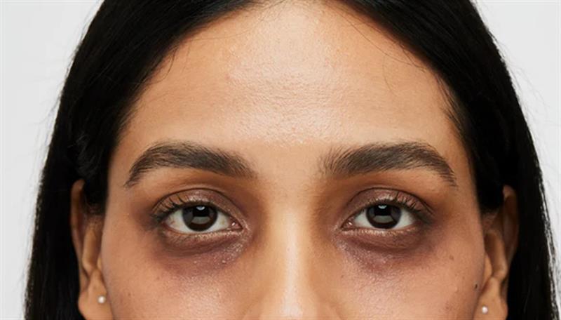 چی دەبێتە هۆی رەشبوونی ژێر چاوەکان؟
