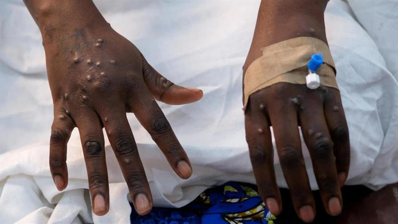 رێکخراوی تەندروستیی جیهانی بڵاوبوونەوەی ڤایرۆسێکی مەترسیداری راگەیاند

