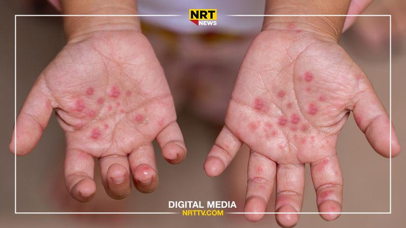 لە مانگێکدا ٣٩ منداڵ لە هەولێر تووشی سوورێژە بوون
