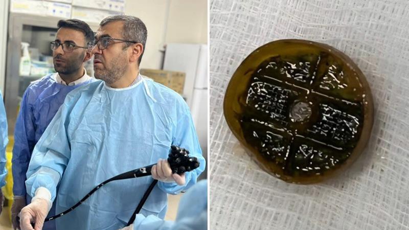لە سلێمانی سەری قوتوویەک لە گەدەی ژنێکی ٩٠ ساڵدا دەرهێنرا