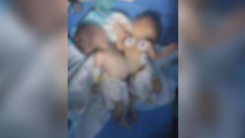 لە کەرکوک بۆ یەکەمجار نەشتەرگەری جیاکردنەوەی دووانەیەک بەسەرکەوتووی ئەنجامدرا