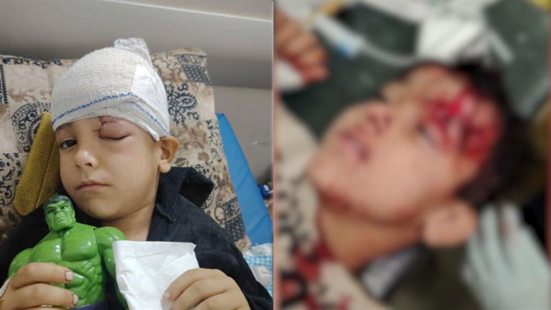 لە کەرکوک سەگی بێلانە پەلاماری منداڵێک دەدات و بە سەختی برینداری دەکات