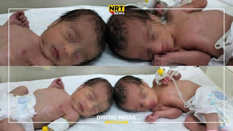 لە رووداوێکی دەگمەندا لە کەرکوک چوار دووانەی کچ لە دایک بوون